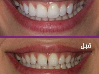 نصائح طبيه طبيعيه لتبييض الاسنان