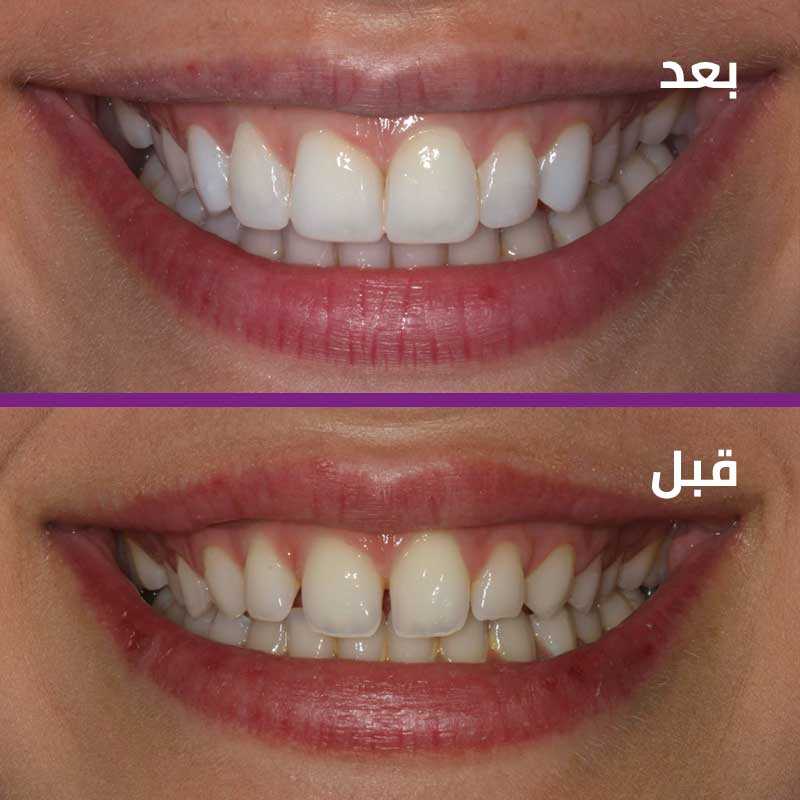 نصائح طبيه طبيعيه لتبييض الاسنان